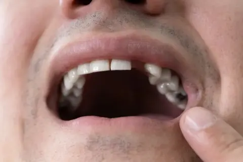 mouth with missing tooth